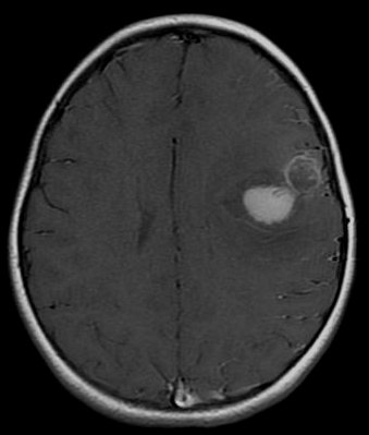 Central nervous system primitive neuroectodermal tumor