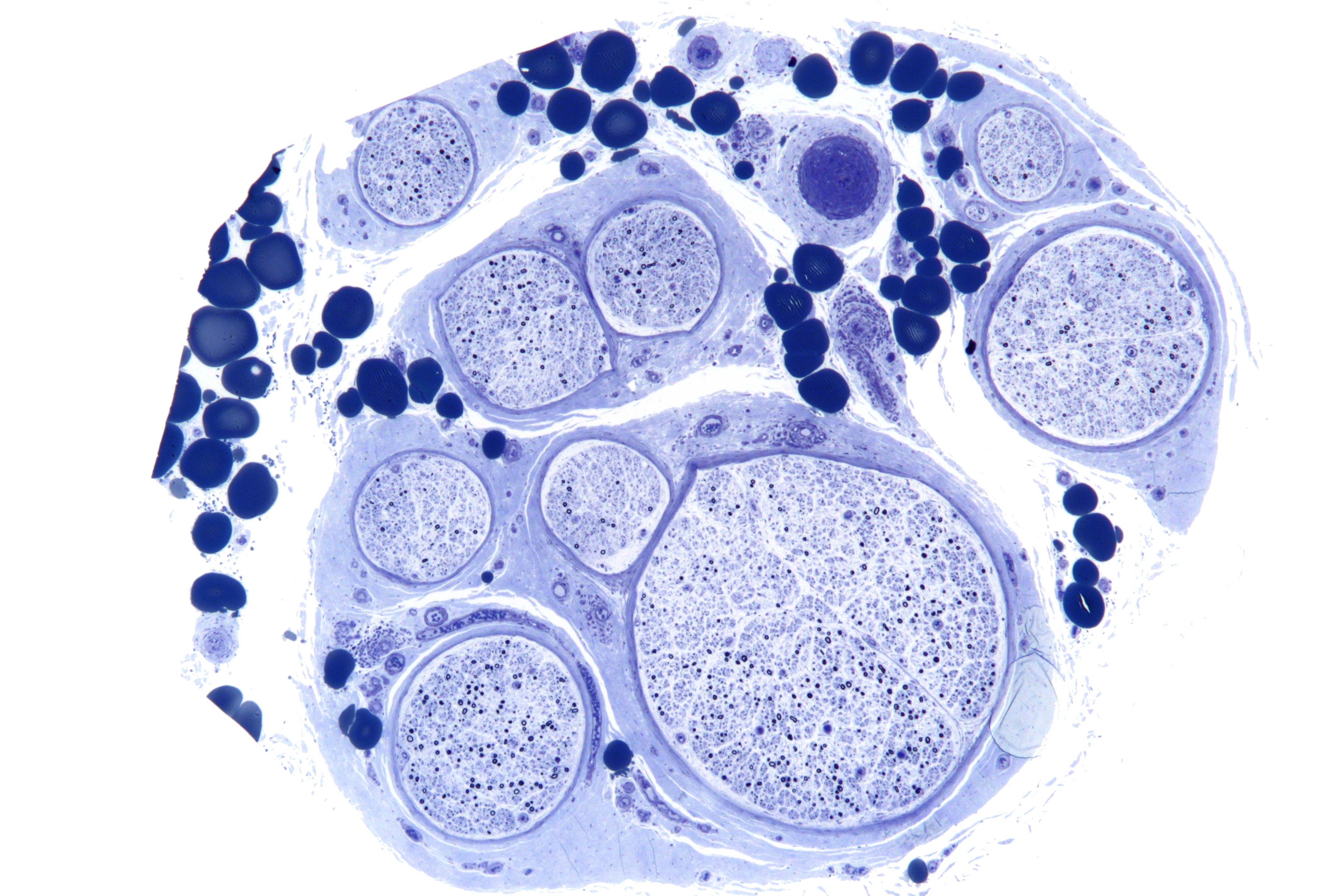 Micrograph of vasculitic neuropathy