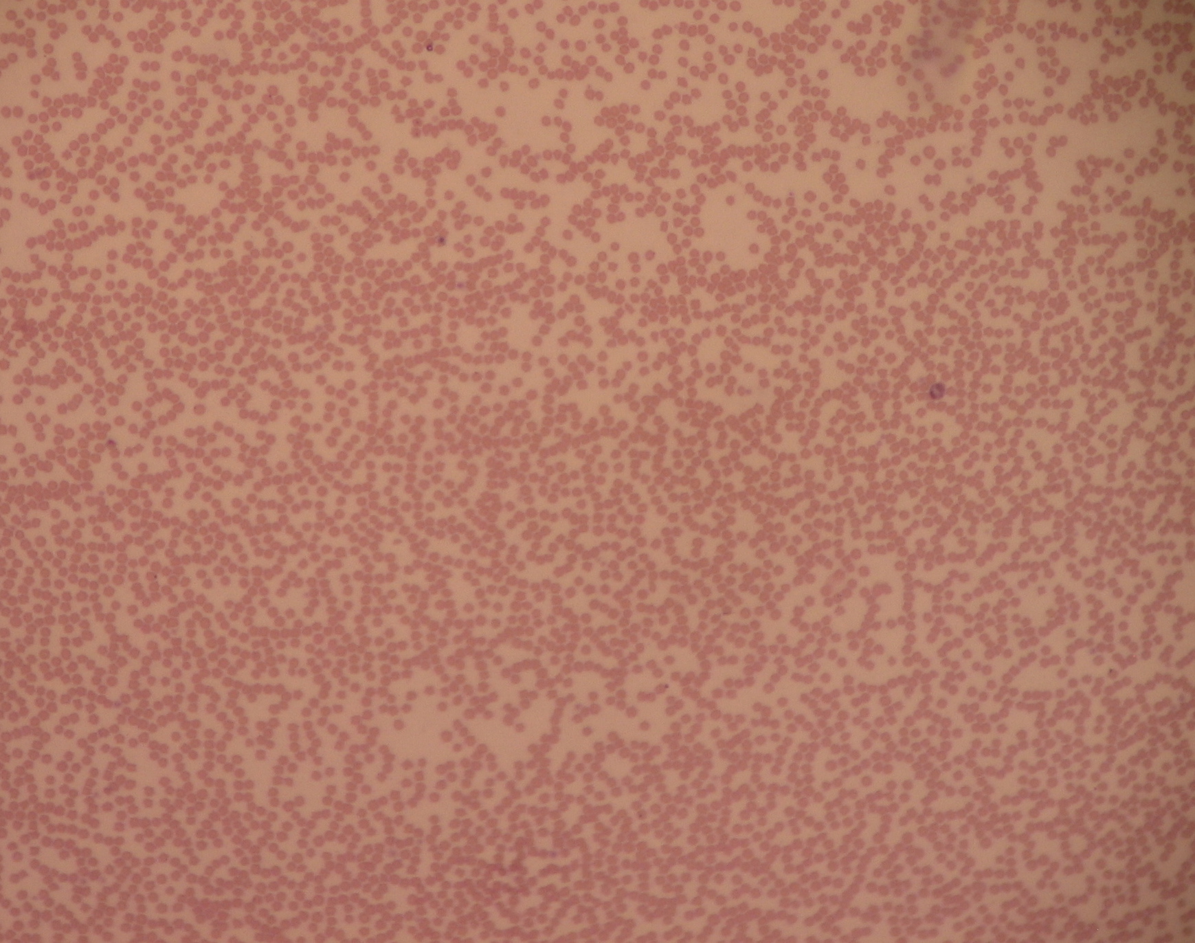 Blood smear showing neutropenia