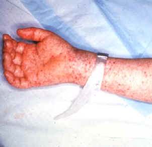Rash on the skin of a person with Rocky Mountain spotted fever