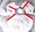 CT scan showing arachnoiditis