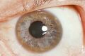Kayser-Fleischer ring, associated with liver disease