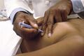 Image of a needle biopsy procedure