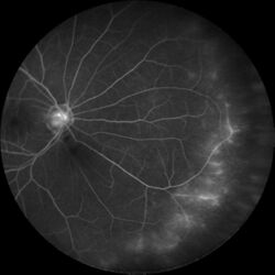 Recurrent-anterior-uveitis-with-quiescent-disease