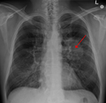 Lung Cancer Chest X-Ray