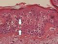 Micrograph of perinuclear vacuolization