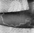 Dracunculus medinensis