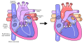 Diagram of the Fontan procedure