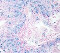 Hemosiderosis at high magnification