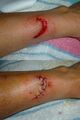 Suture before and after