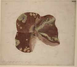 Liver with purulent deposits