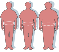 Diabetes management