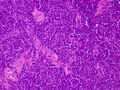 List of vaginal tumors