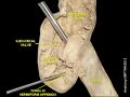 Ileocecal valve