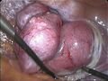 Vaginal evisceration