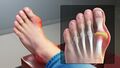 Gout Signs and Symptoms