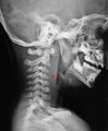CT scan showing a retropharyngeal abscess