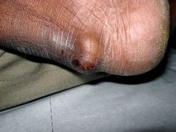 Tophus achilles tendon
