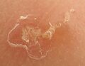 Scabies Burrow