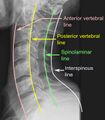 X-ray of vertebral lines