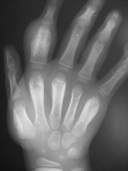 Dactylitis caused by osteoperiostitis due to yaws