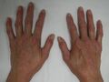 CREST syndrome
