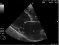 B-Mode echocardiogram of dilated cardiomyopathy