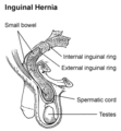 Inguinal canal