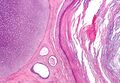 Teratoma