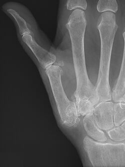 Trapeziometacarpal osteoarthritis with subluxation