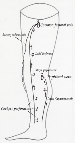 Accessory_saphenous_vein2