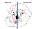 Tessier classification of craniofacial clefts