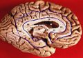 Inferior-medial view of human brain