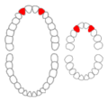 Maxillary lateral incisor agenesis