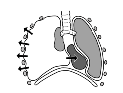 Tension-pneumothorax illustration of a tension pneumothorax showing deviated trachea and collapsed lung