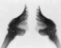 Bound Feet (X-ray)