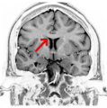 Corpus callosum