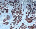 Proximal tubule CD10 immunohistochemistry