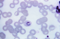 Plasmodium ovale