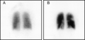 Pulmonary embolism scintigraphy