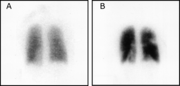 Ventilation-perfusion scintigraphy