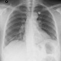 Mediastinal shift