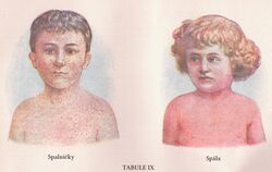 Measles and Scarlet Fever