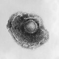 Varicella (Chickenpox) Virus