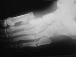 Charcot arthropathy X-ray