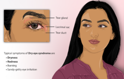 Depiction of a person suffering from Dry Eye Syndrome