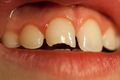 Front tooth, incisal edge broken