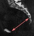 Sagittal pelvic outlet diameter