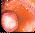 Small bowel polyp observed during double-balloon enteroscopy