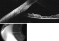 Iris (anatomy)